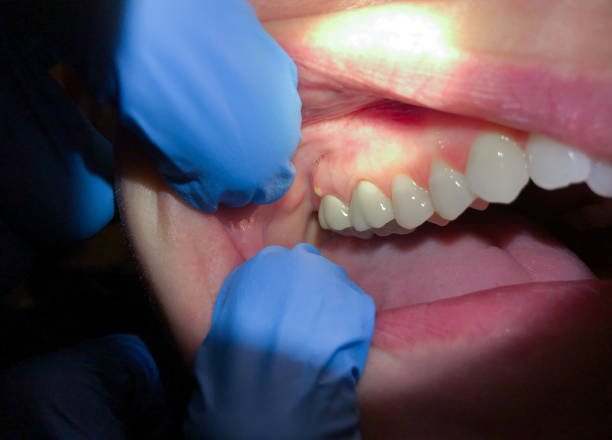 Best Urgent Tooth Repair  in Hamilton, MO